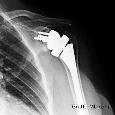 Reverse total shoulder replacement xray