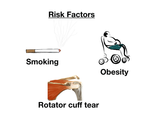 Rotator cuff tear risk factors