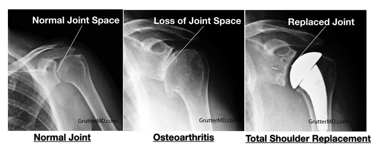 Shoulder arthritis treatment